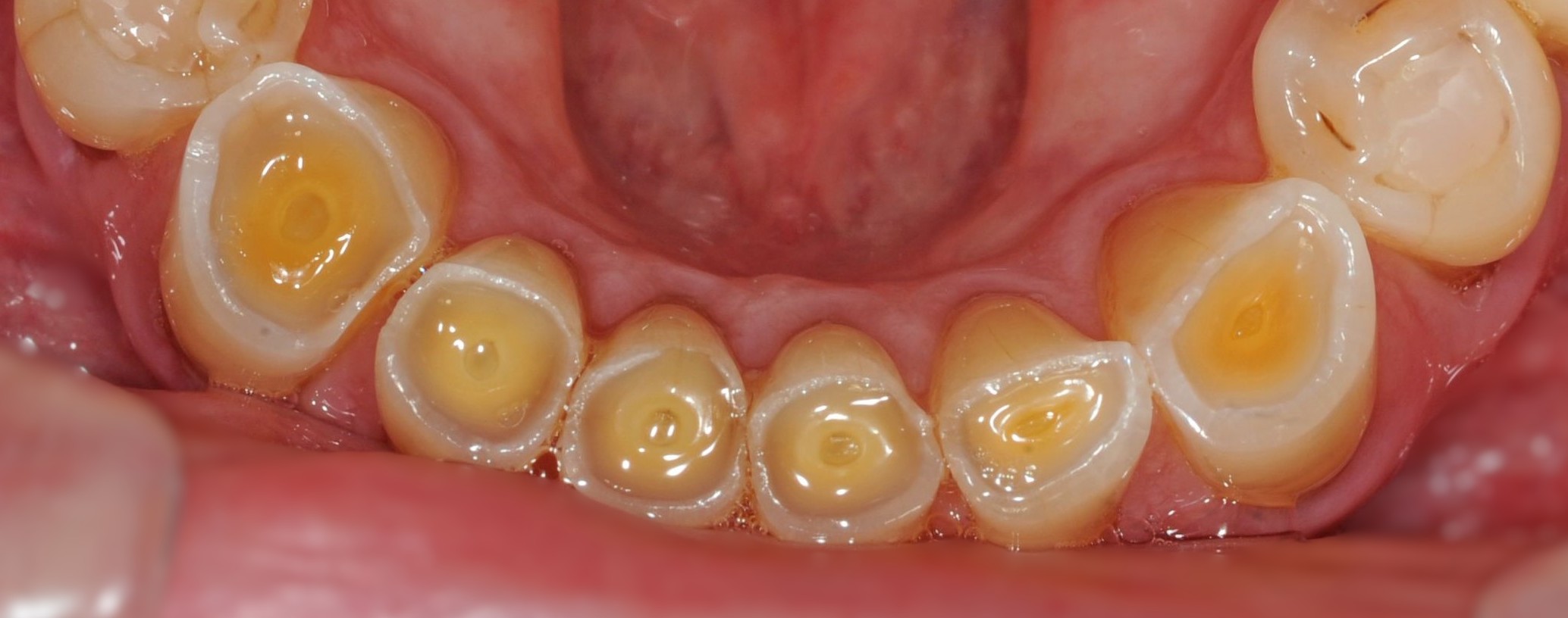 Οδοντική φθορά (Tooth wear): Αίτια, πρόληψη και αντιμετώπιση