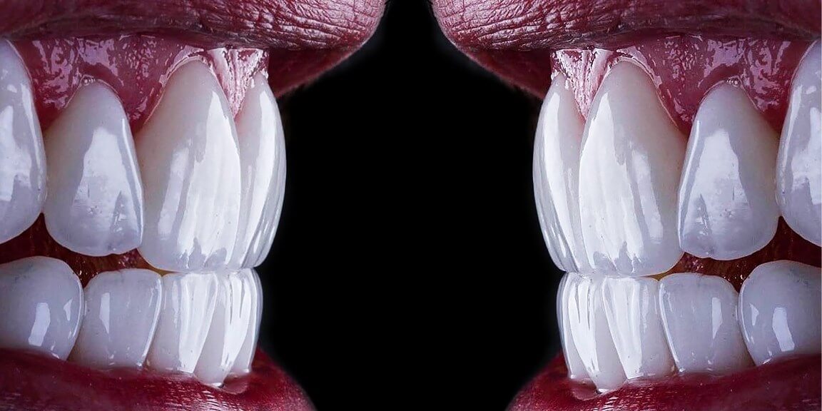 Όψεις ρητίνης ή πορσελάνης;