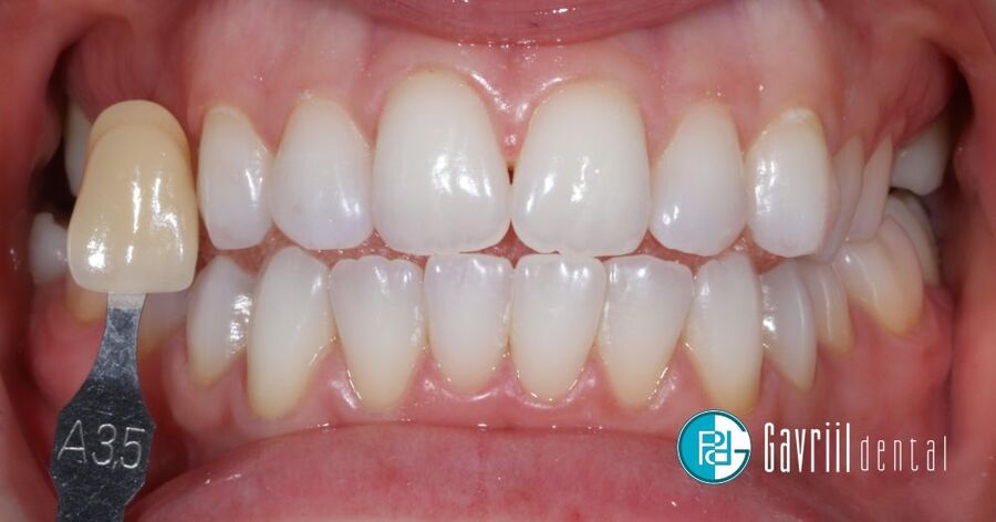 lefkansh sto spiti meta