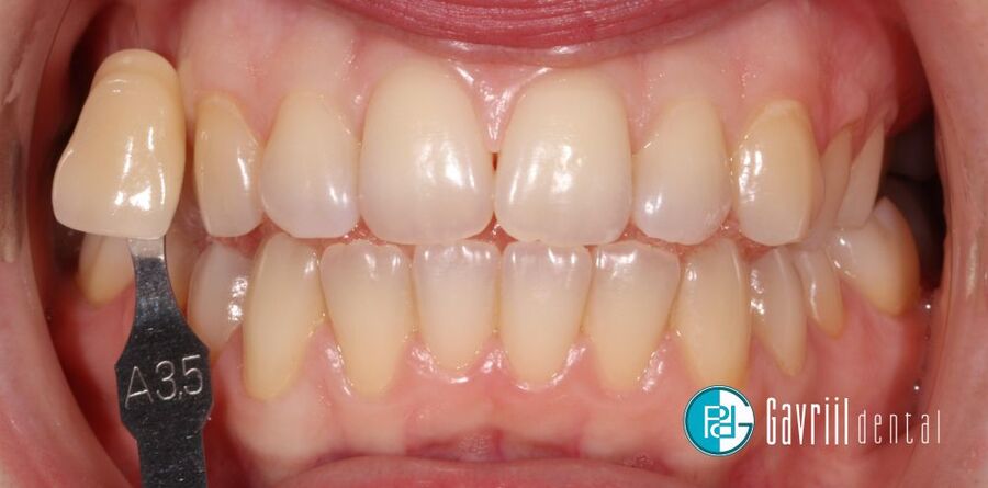 lefkansh sto spiti prin